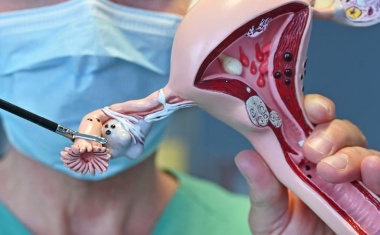 Krebsprävention: Eierstockkrebserkrankungen senken