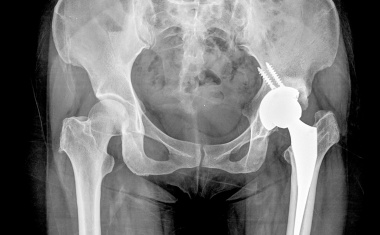 Metallbelastung durch Gelenkimplantate