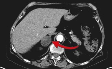 Vom Bluthochdruck geheilt
