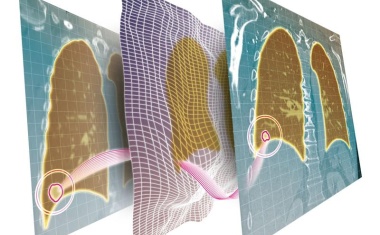 Therapiebedingte Veränderungen auf CT-Bildern