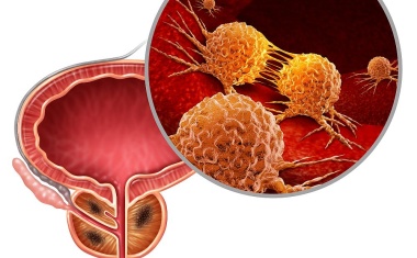 S3-Leitlinie zum Prostatakarzinom aktualisiert