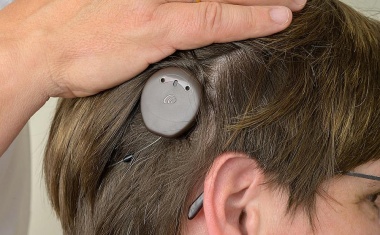 FAU: Erstes smartes Hörsystem implantiert