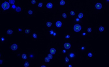 Herzinfarkt trotz Medikamenten