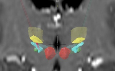 Hirnschrittmacher hilft bei Stottern