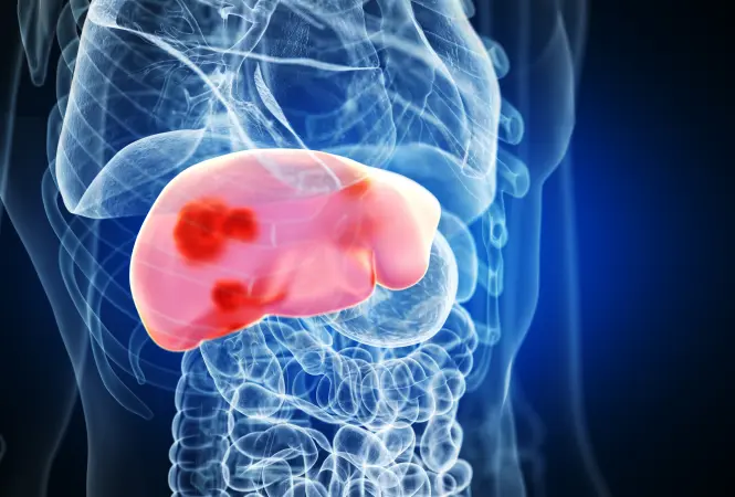 Vorsorge verbessern: KI-Modell zur Einschätzung des Leberkrebsrisikos