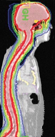 Die Bestrahlung des zentralen Nervensystems ist mit dem TomoTherapy-System in...