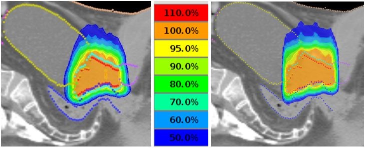 Durch den Einsatz der neuen TomoEDGE Blenden wird die Bestrahlungsdauer...