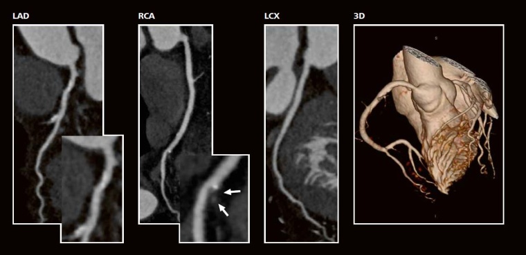 Fall 1: 77-jährige Dame, Aufnahme wg. paroxysmalem Vorhofflimmern, zu den...