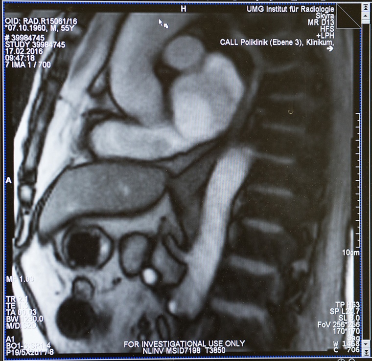 Standbild aus dem Echtzeit-MRT zeigt die Speiseröhre und den Übergang zum...