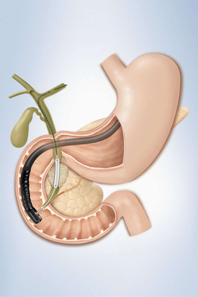 Über Herausforderungen in der ERCP veranstaltet Olympus (Halle H, Stand B.22...