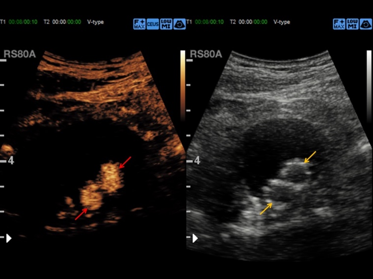 Kontrastverstärkte Sonographie, Untersuchung im Dual-Modus (CEUS-Bild und...