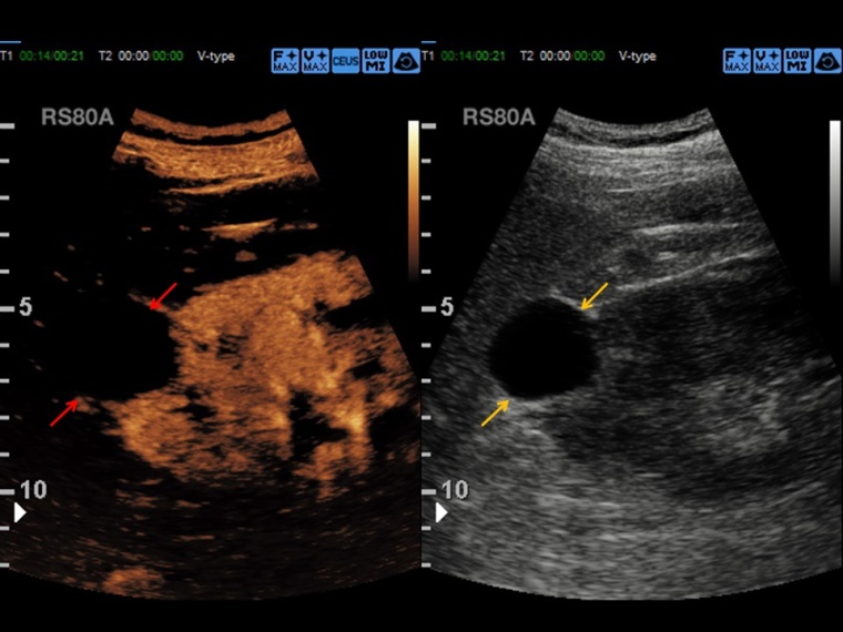Kontrastverstärkte Sonographie, Untersuchung im Dual-Modus (CEUS- und B-Bild)...