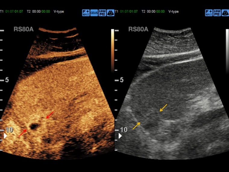 Kontrastverstärkte Sonographie, Untersuchung im Dual-Modus. In der...