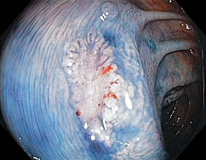Weitere Detailanalyse desselben Polypens mittels Chromoendoskopie...