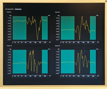 QRS-Fragmentierung bei einem hochgradig gefährdeten Patienten