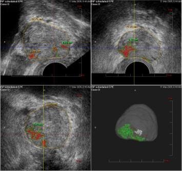 Verdächtiges Areal (farbig markiert) vorwiegend im rechten Seitenlappen, auf...