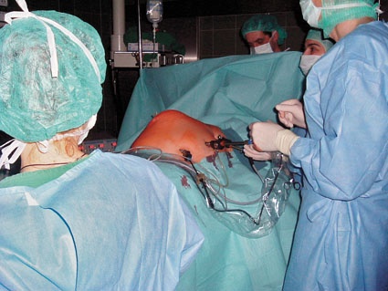 Abb. 2: Laparoskopische Sublayoperation: 5 x 5 cm große Bruchpforte...