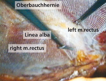 Abb. 3: Sublayposition eines großen Kunststoffnetzes