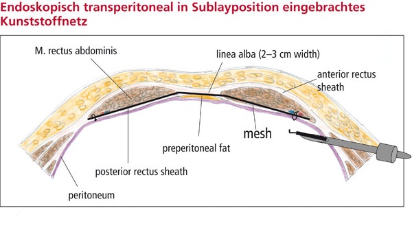 Abb 1. Endoskopisch transperitoneal in Sublayposition eingebrachtes...