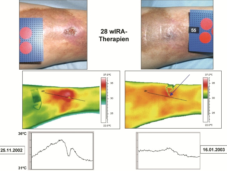 Erfolgreicher Therapieverlauf mit wIRA mit normaler Aufsicht, thermographischem...