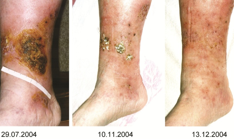 Erfolgreiche Therapie bis zum kompletten Wundschluss nach ca. fünf Monaten mit...