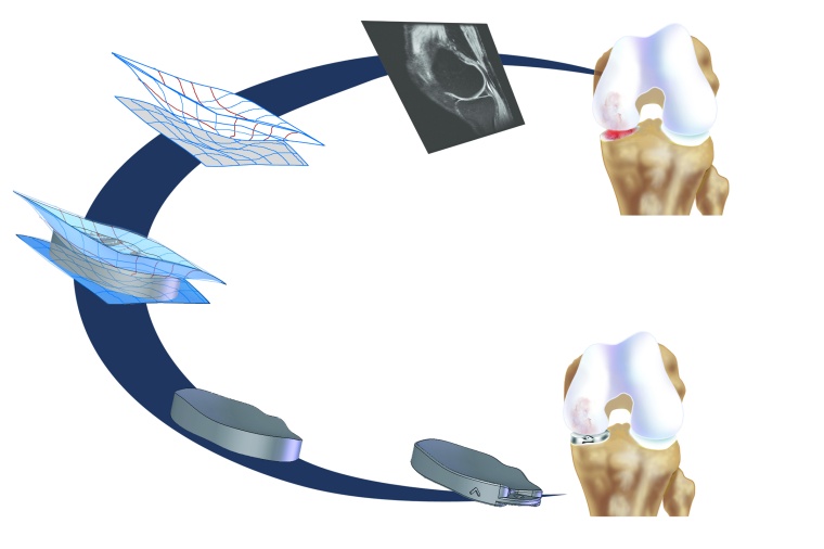 Einsatz der iFit Technologie zur Herstellung eines individuellen Implantates...