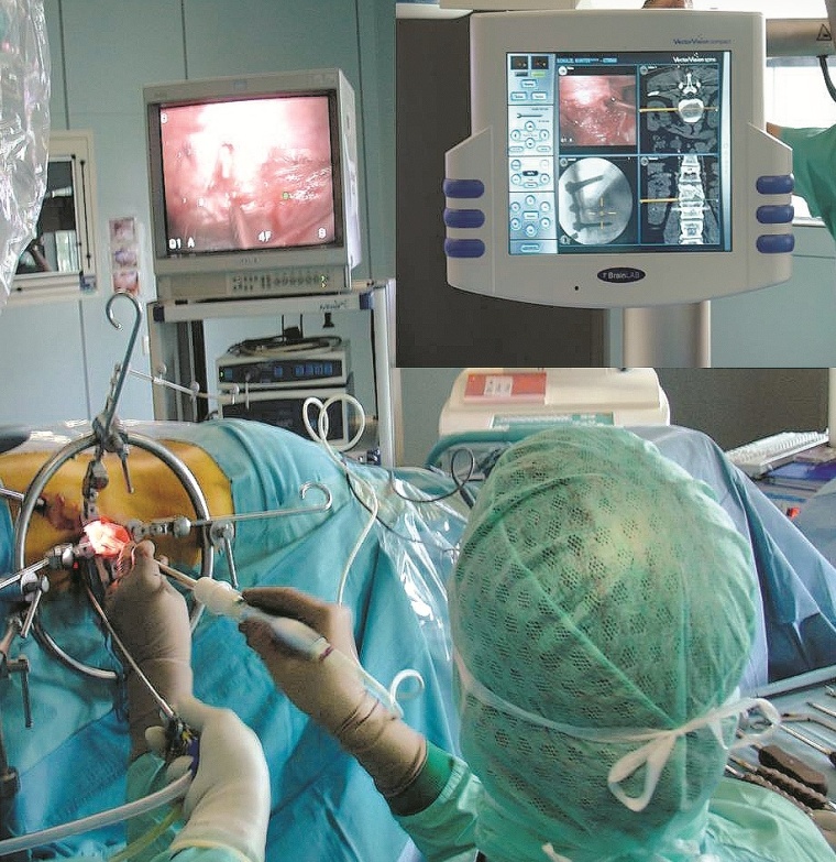 Ventrale Versorgung auf Höhe L3 in Bauchlage unter Einsatz eines Synframe...