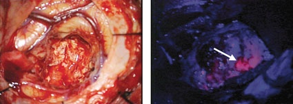 Abb. 1: Glioblastom durch das Operationsmikroskop unter Weißlicht (links)...