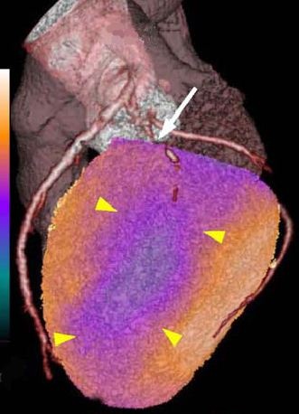 Laterale Perfusionsstörung (Pfeilspitzen) verursacht durch einen...