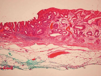 Magenfrühkarzinom. Endoskopische Submukosa-Dissektion (en-bloc R0-Resektion):...