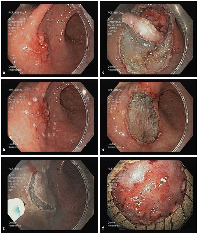 Magenfrühkarzinom. Endoskopische Submukosa-Dissektion (en-bloc R0-Resektion):...