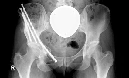 3-fach-Beckenosteotomie mit Pfannenstellungskorrektur (Abb.: Klinik für...