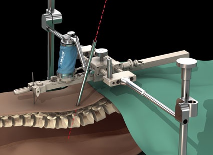 Abb. 1: Der Roboter wird vor der Operation an der Wirbelsäule des Patienten...