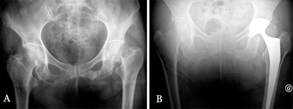 Photo: Tripolare Hüftpfanne für eine primäre Hüft-TEP bei Patienten mit...