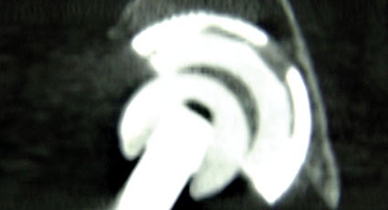 Figure 3: Mismatched ceramic head and ceramic insert (Courtesy Dr. Tarik Aït...