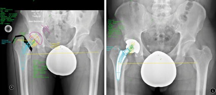 Abb. 1: Fallbeispiel von Planung und Operation einer MiniHip, (Patient...