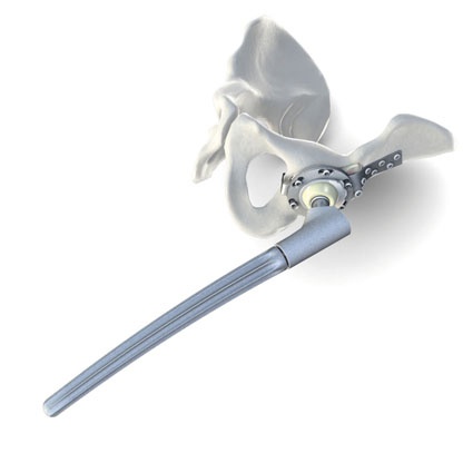 Abb. 1: Hüft-Endoprothese aus Titan