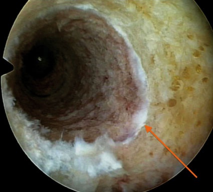 Abb.1: Femoraler Bohrkanal mit weißem Wachstumsfugenring (Foto: ATOS Klinik...