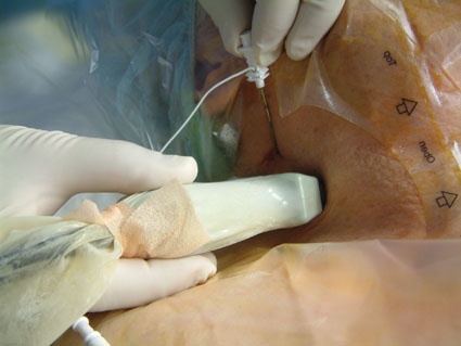 Abb. 1: Ultraschallgesteuerte Lokalanästhesie bei einer Plexusanästhesie...