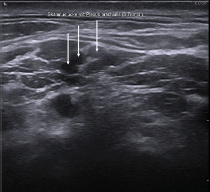 Abb. 2: Ultraschallbild eines Nerven im Rahmen einer Plexusblockade (zu sehen...