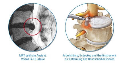 Abb.1: Der einzigartige Zugang zum Bandscheibenvorfall durch die natürliche...