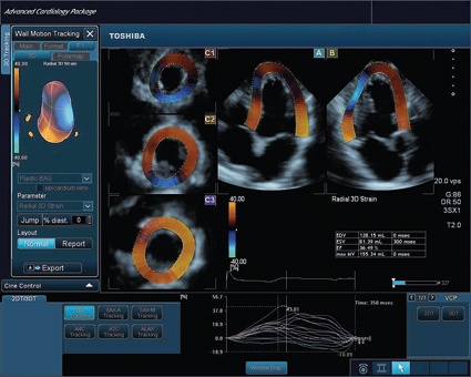 Abb. 1: 3D Speckle Tracking mit quantitativer und parametrischer Darstellung...