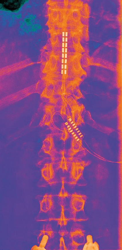 Abb. 1: Epidurale Rückenmarksstimulation bei chronischen Lumboischialgien...