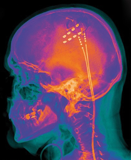 Abb. 2: Motorcortexstimulation bei atypischem Gesichtsschmerz