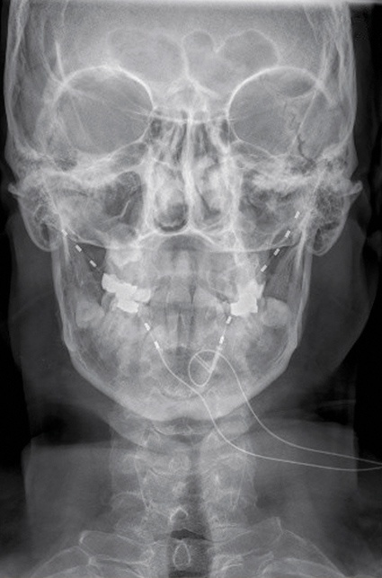 Abb. 3: Occipitalisstimulation bei Clusterkopfschmerz