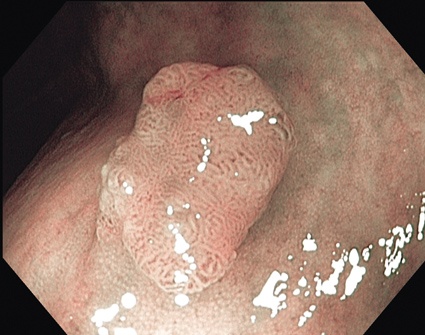Abb 1: Die Oberflächenstruktur des Gewebes wird durch die NBI-Technik deutlich...