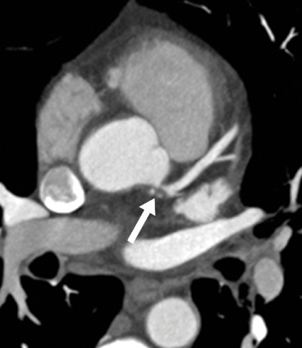 Abb. 1: Transversale Dünnschicht-MIP einer CT-Koronarangiografie: Der Pfeil...