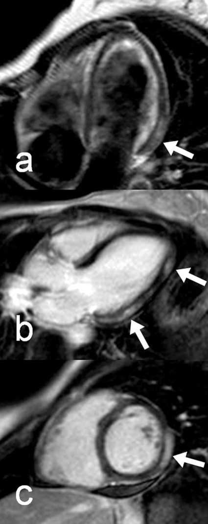 Abb. 2: MRT mit den typischen Befunden einer akuten Myokarditis: Die...