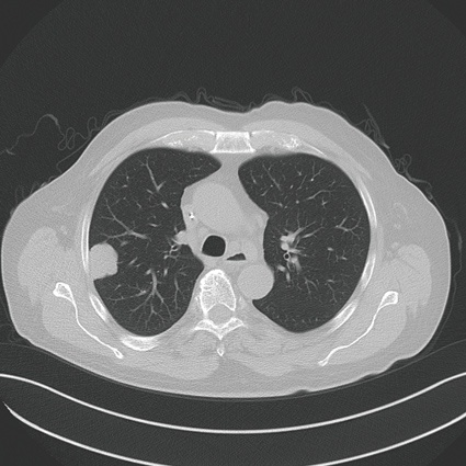 Lungenmetastase bei Z.n. Rektumkarzinom, minimalinvasive Ablation mittels...