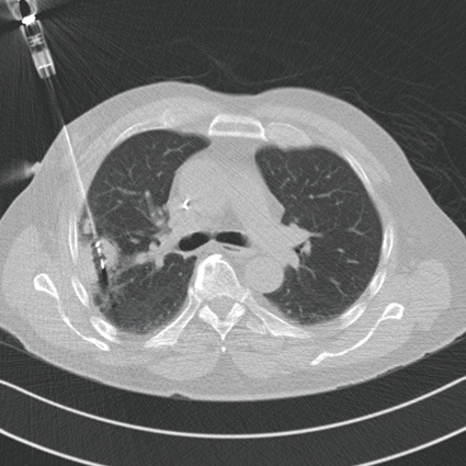 Lungenmetastase bei Z.n. Rektumkarzinom, minimalinvasive Ablation mittels...